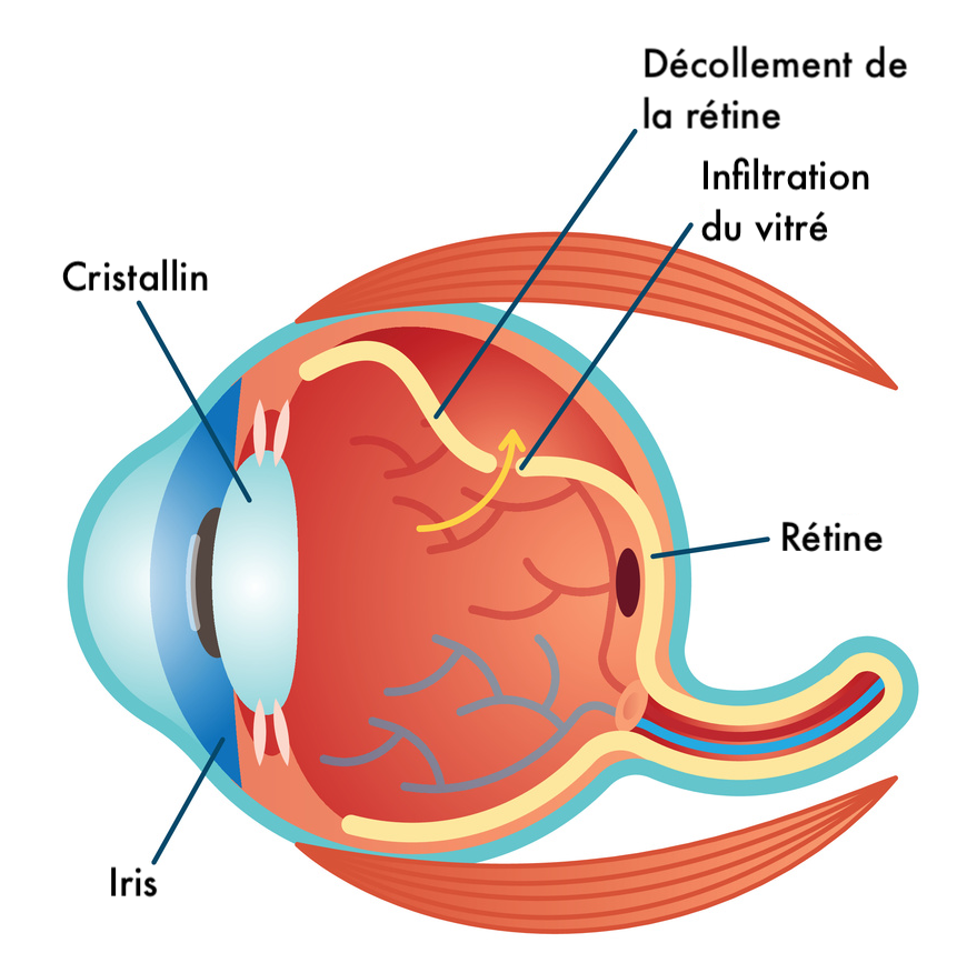 Définition Décollement de la rétine